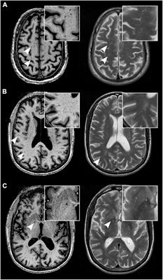 The etiology and evolution of magnetic resonance imaging-visible perivascular spaces: Systematic review and meta-analysis